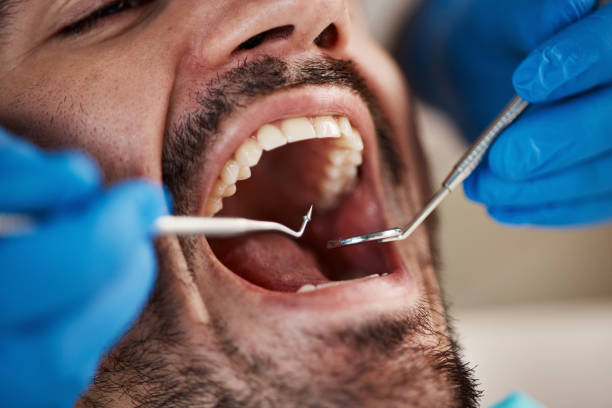 Best Emergency Treatment for Dental Infections or Abscesses in Santa Maria, CA