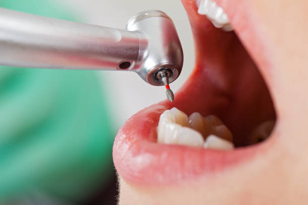 Best Emergency Root Canal Treatment in Santa Maria, CA